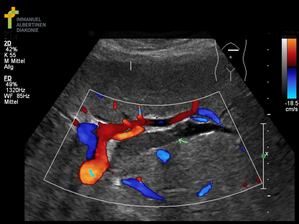 Ultraschall Gallenwege